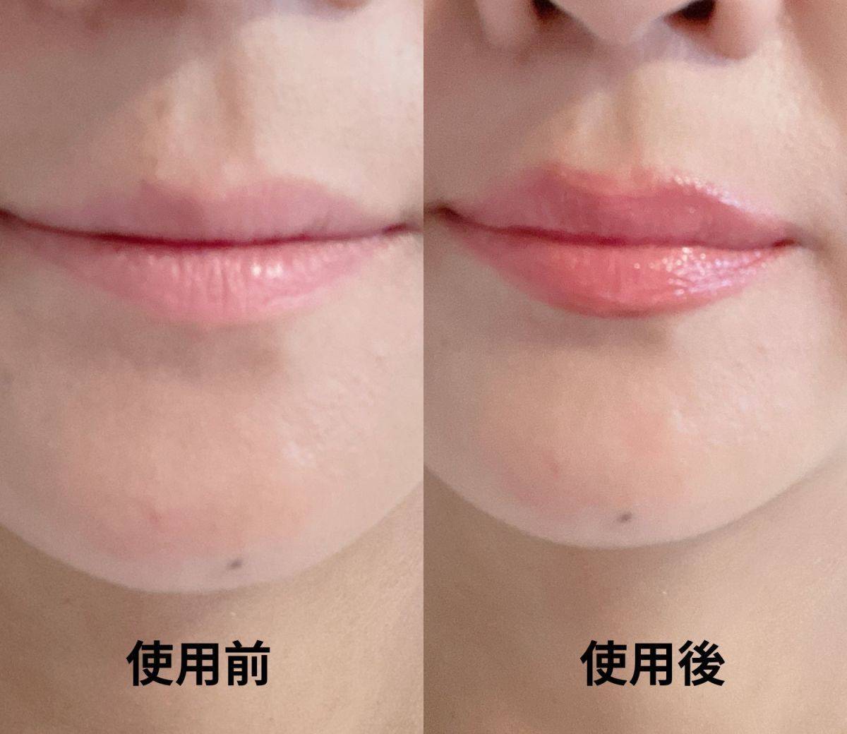 リンメル使用後