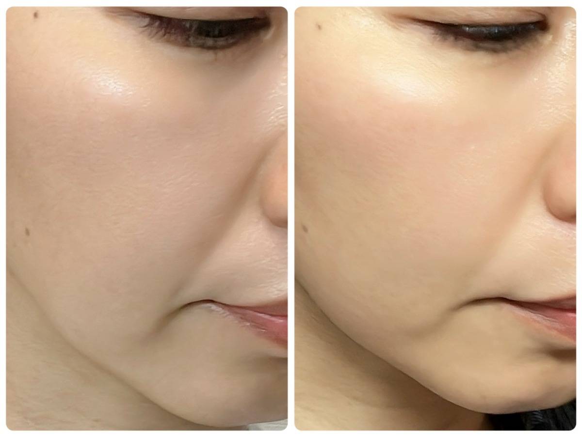 バイオヒールボ プロバイオダーム3Dリフティングクリーム使用前後