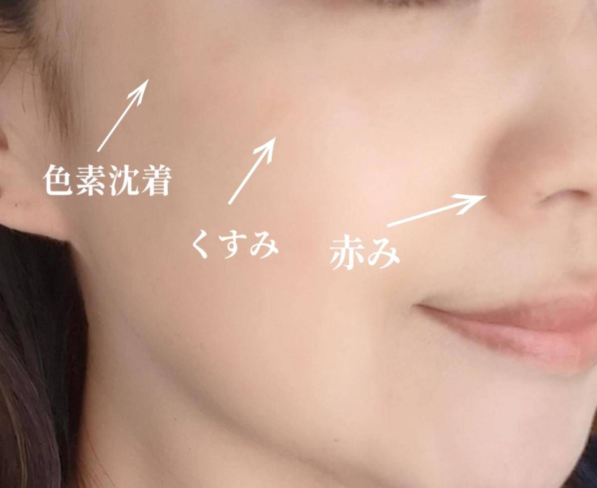 肌の色むらの気になる部分